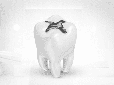 Dental Fillings