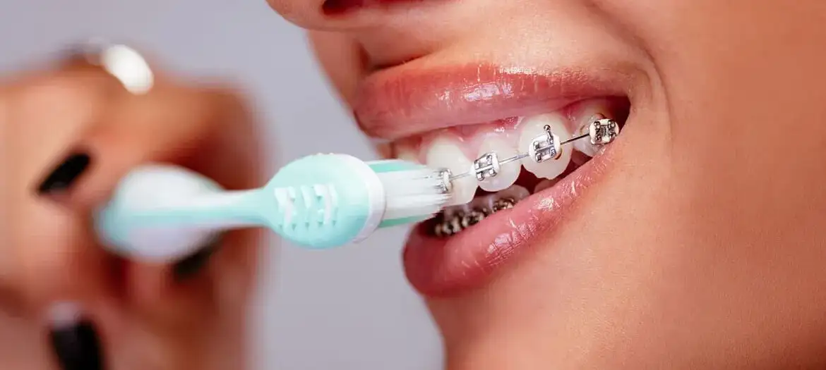 سعر تقويم الاسنان في مصر 2025