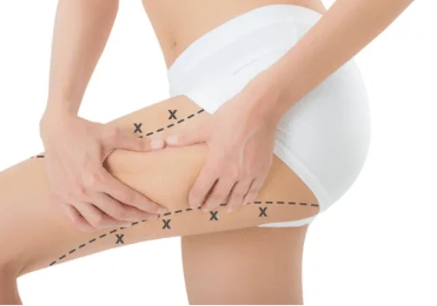  علاج ترهلات الفخذين| الاسباب،الطرق والوقاية