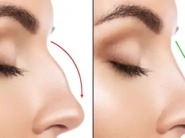 عملية تصغير الانف| دليلك الشامل مع الجمل كلينيك