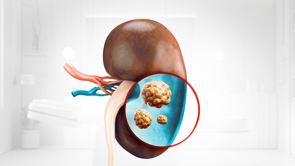 تفتيت حصوات الكلى والحالب والمثانة