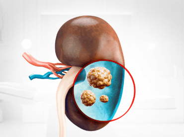 Breaking down kidney, ureter, and bladder stones