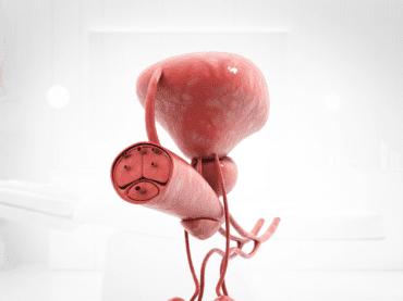 Diagnosis and treatment of varicocele