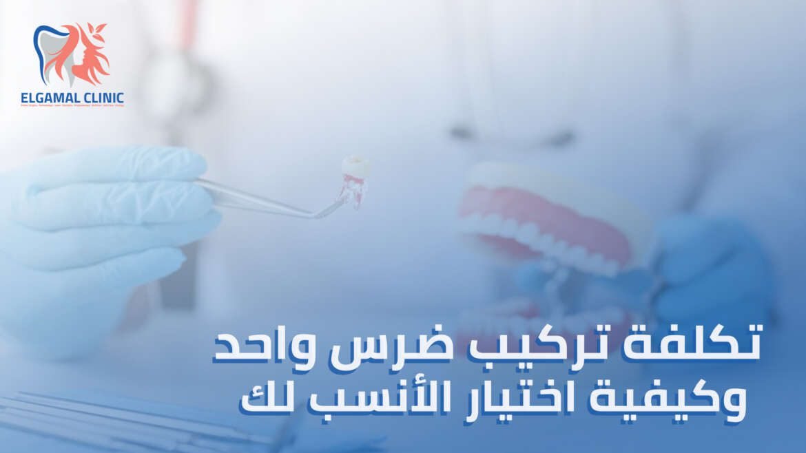 سعر تركيب ضرس واحد: تكلفة تركيب الأسنان الثابتة وكيفية اختيار الحل الأنسب