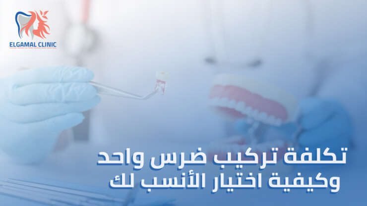 سعر تركيب ضرس واحد: تكلفة تركيب الأسنان الثابتة وكيفية اختيار الحل الأنسب