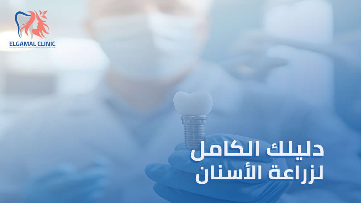 أنواع زراعة الأسنان: دليل شامل لاختيار النوع الأنسب لتعويض الأسنان المفقودة