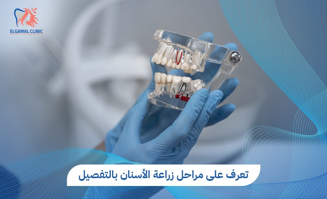 مراحل زراعة الأسنان خطوة بخطوة: من التحضير إلى التاج النهائي