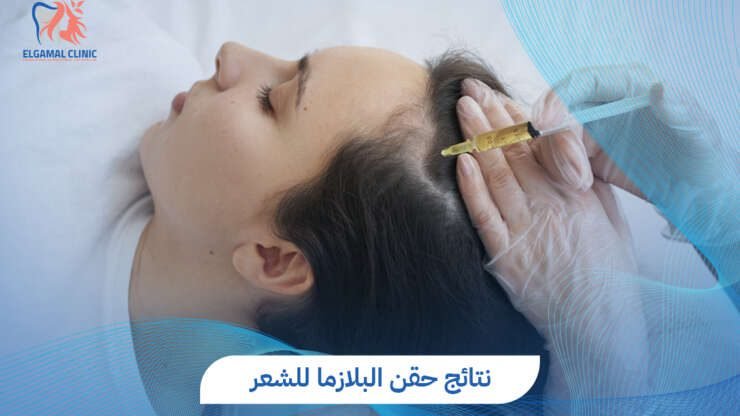 تجربتي مع حقن البلازما للشعر