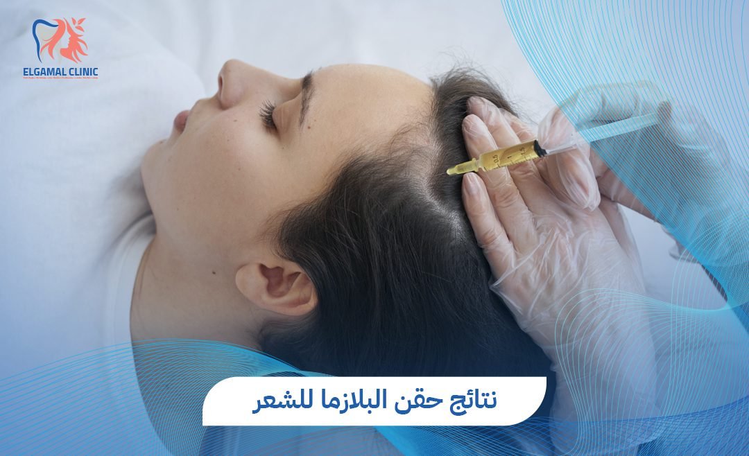 تجربتي مع حقن البلازما للشعر 