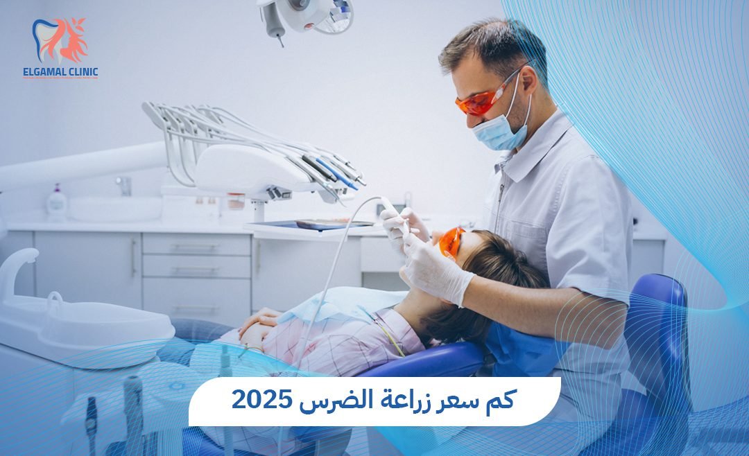 سعر زراعة الضرس في مصر: التكلفة والعوامل المؤثرة وخيارات العلاج