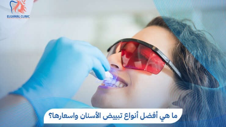 أنواع تبييض الأسنان واسعارها في مصر – عيادات الجمل 