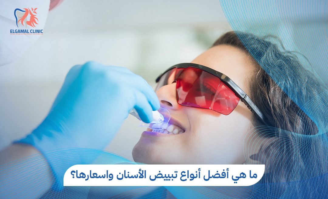 أنواع تبييض الأسنان واسعارها في مصر – عيادات الجمل 