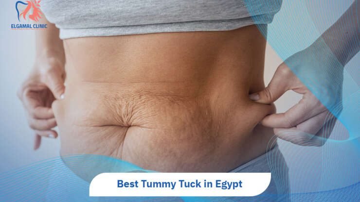 Tummy Tuck in Egypt | Cost, Recovery & Best Surgeons.