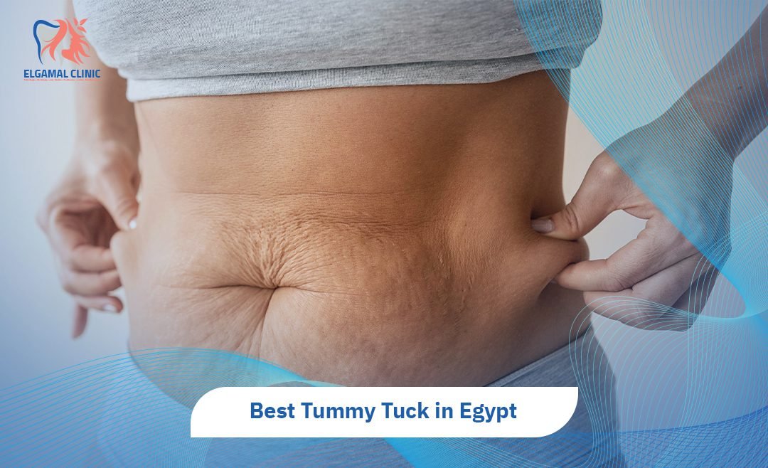 Tummy Tuck in Egypt | Cost, Recovery & Best Surgeons.