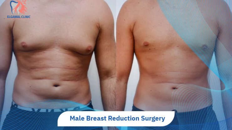 Male Breast Reduction in Cairo | Gynecomastia Surgery Cost