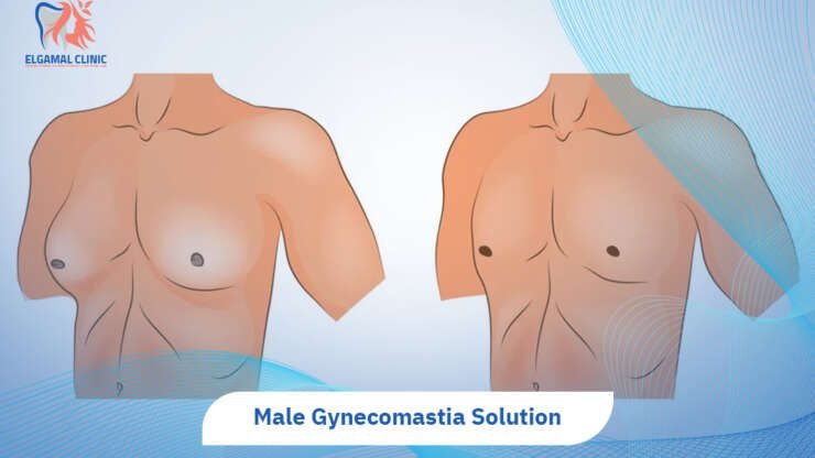 Male Gynecomastia treatment in Cairo | Causes & Surgery