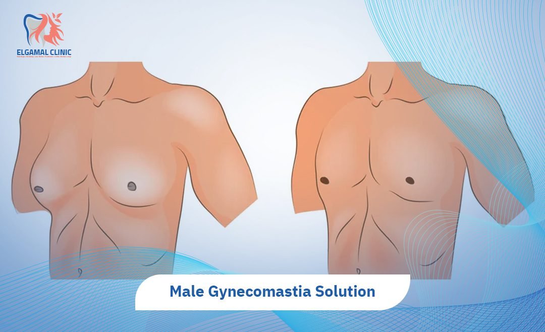 Male Gynecomastia treatment in Cairo | Causes & Surgery