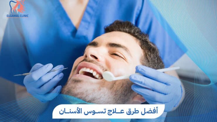 علاج تسوس الاسنان | افضل طرق الوقاية والحلول مع عيادات الجمل