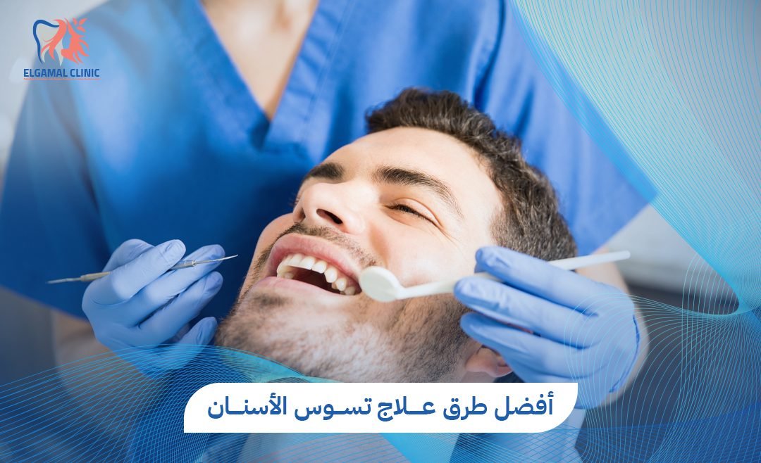 علاج تسوس الاسنان | افضل طرق الوقاية والحلول مع عيادات الجمل