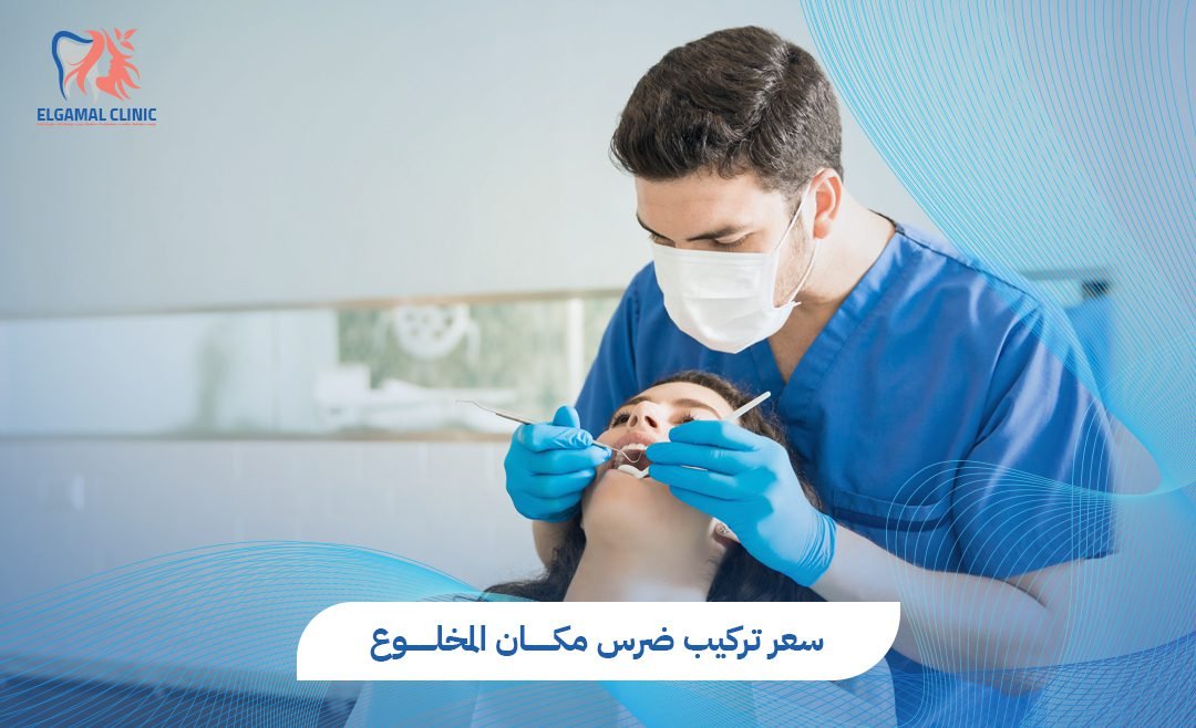 سعر تركيب ضرس مكان المخلوع | افضل عيادة تركيبات وزراعة اسنان