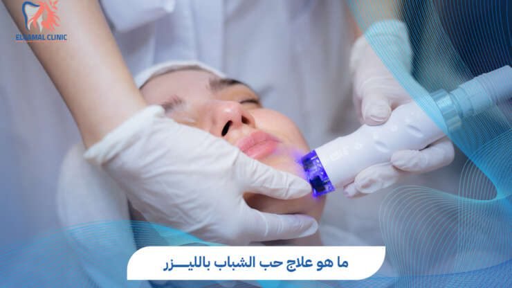 علاج حب الشباب بالليزر في مصر | التكلفة والنتائج المتوقعة