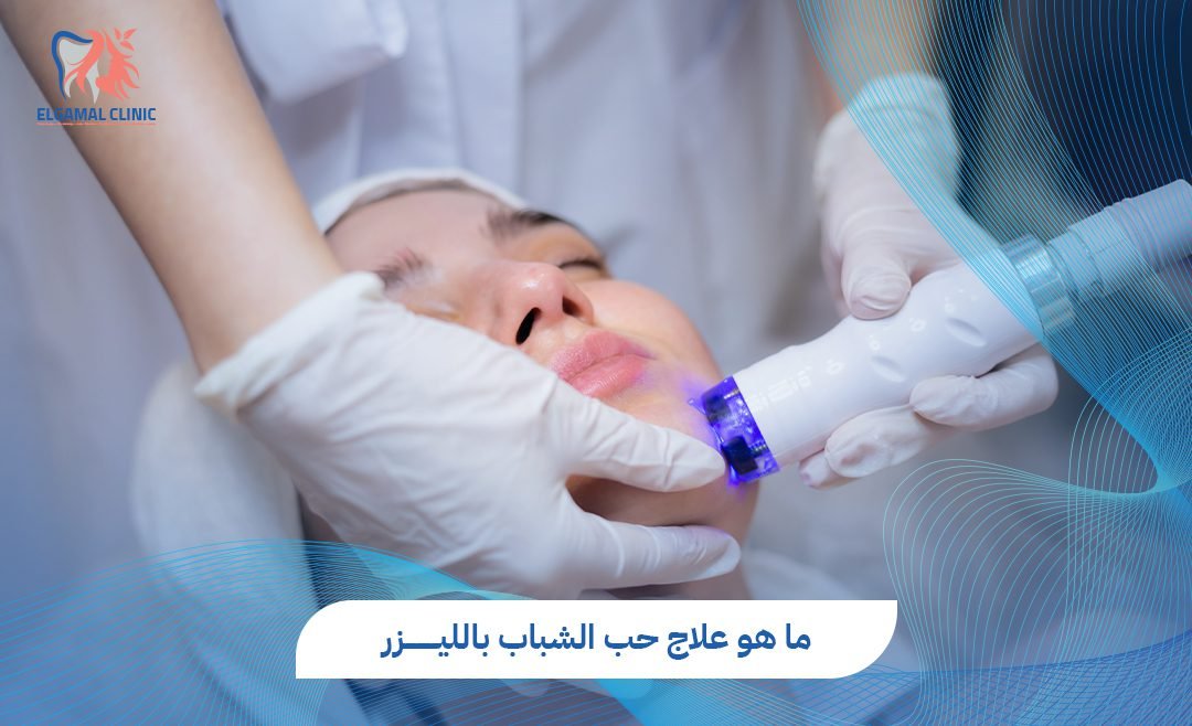 علاج حب الشباب بالليزر في مصر | التكلفة والنتائج المتوقعة