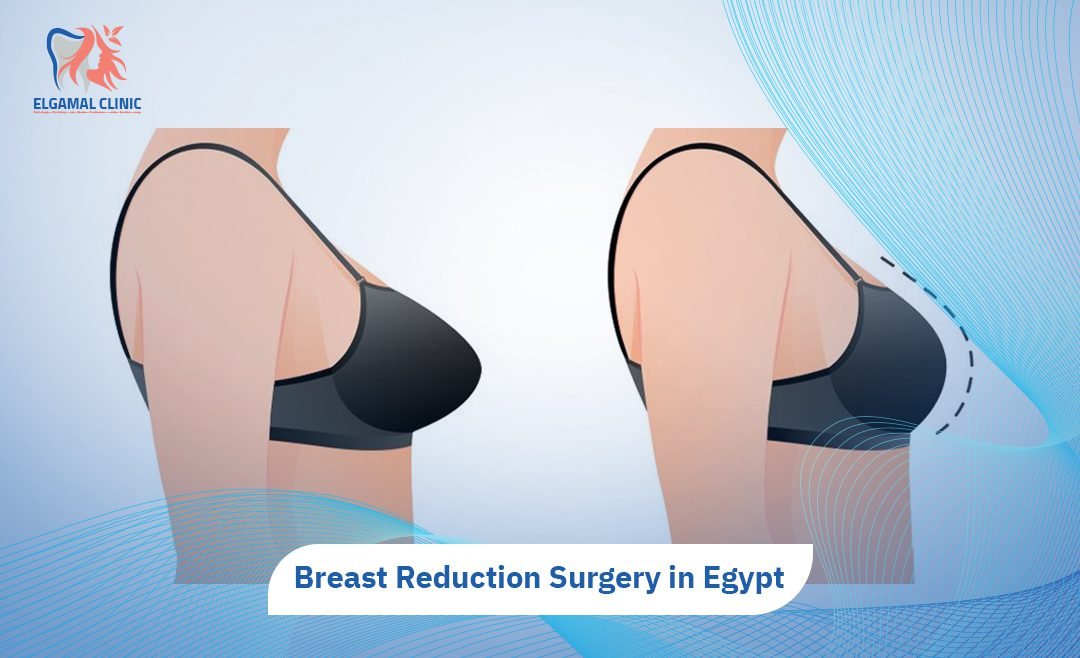 Breast Reduction Surgery in Egypt | El Gamal Clinics.