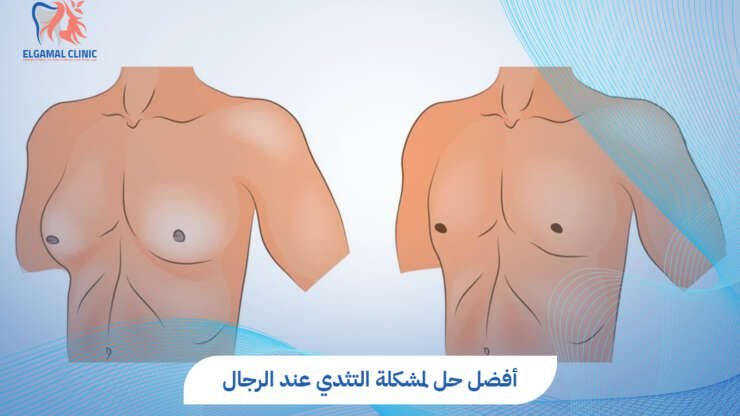 حل مشكلة التثدي عند الرجال | أفضل طرق علاج فعال.