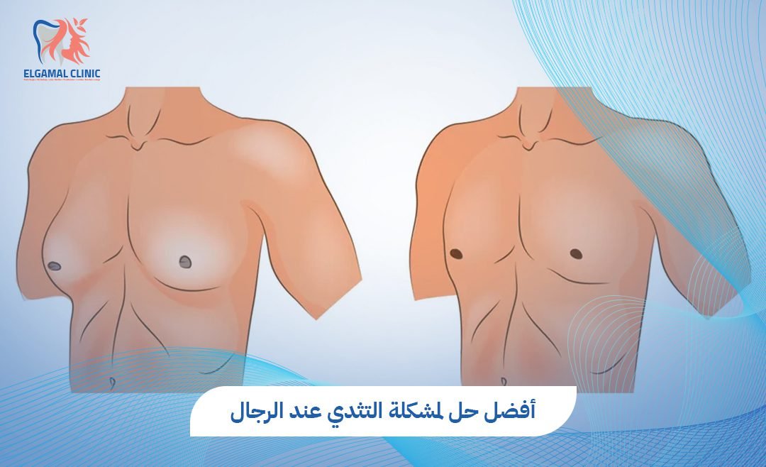 حل مشكلة التثدي عند الرجال | أفضل طرق علاج فعال.