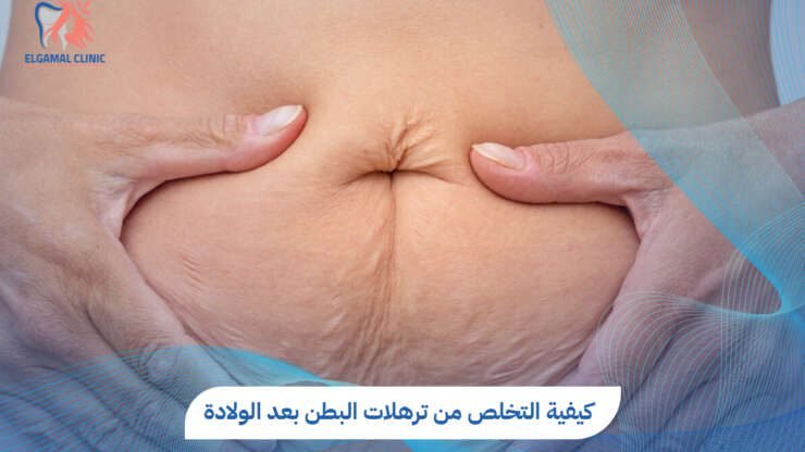 حلول للتخلص من ترهلات البطن بعد الولادة بسرعة