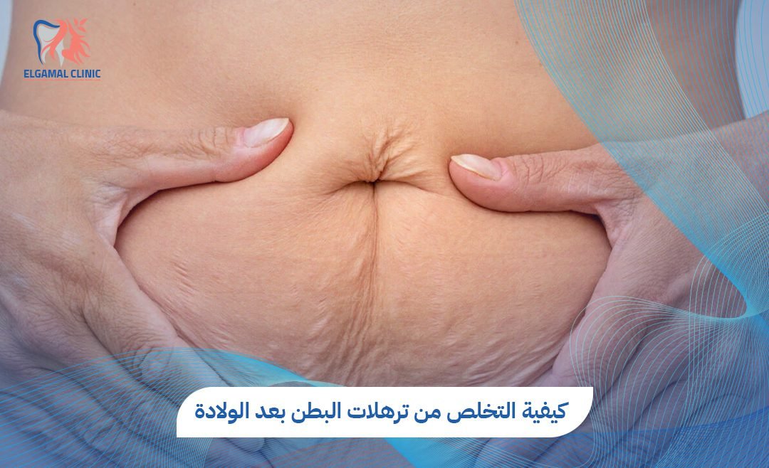 حلول للتخلص من ترهلات البطن بعد الولادة بسرعة