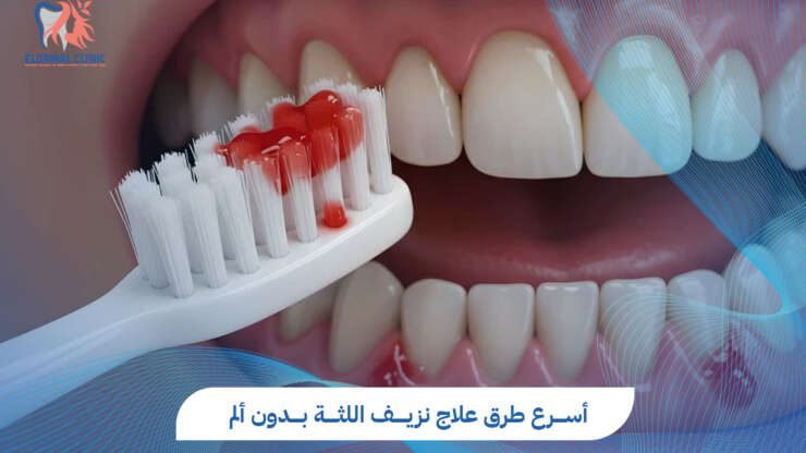 علاج نزيف اللثة: الأسباب والعلاج | عيادات الجمل