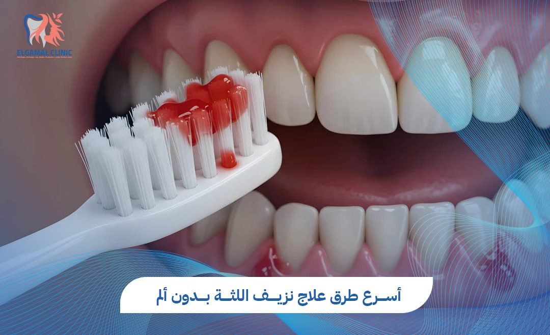 علاج نزيف اللثة: الأسباب والعلاج | عيادات الجمل