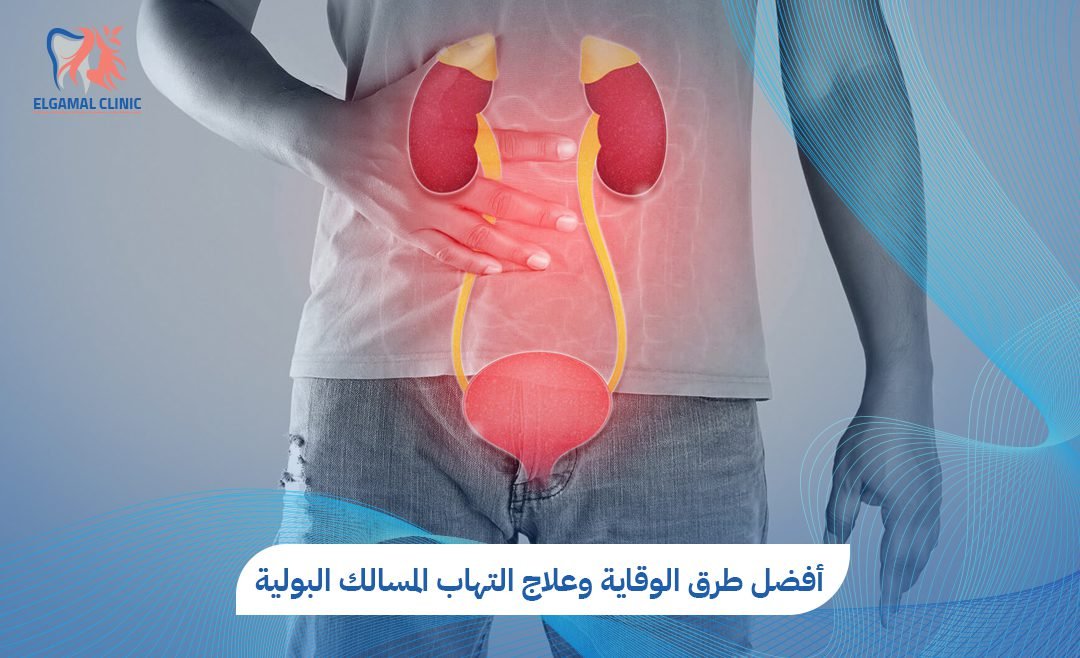 التهاب المسالك البولية: الأعراض والعلاج | عيادات الجمل