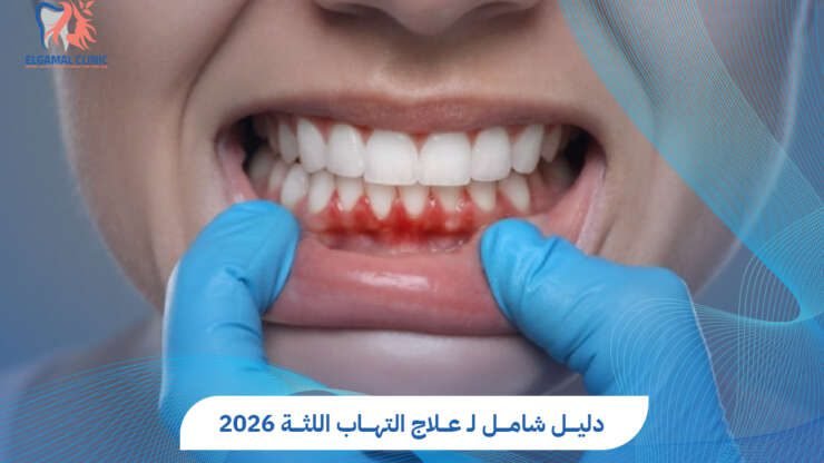 علاج التهاب اللثة: خطوات فعالة للحفاظ على صحة فمك