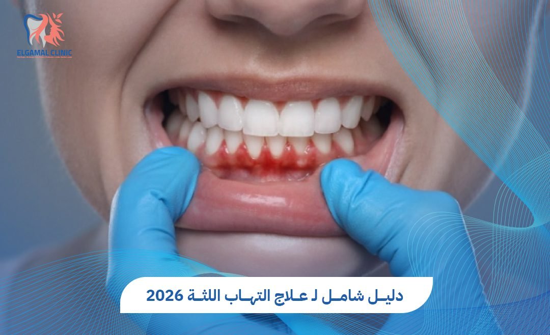 علاج التهاب اللثة: خطوات فعالة للحفاظ على صحة فمك