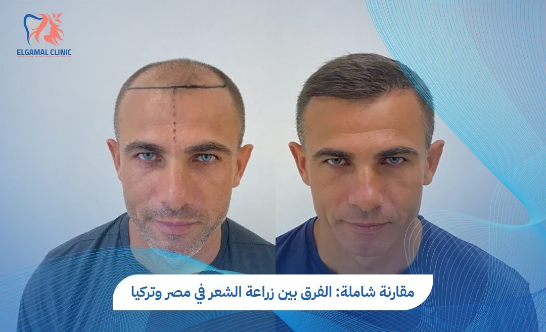 الفرق بين زراعة الشعر في مصر وتركيا: أيهما أفضل؟