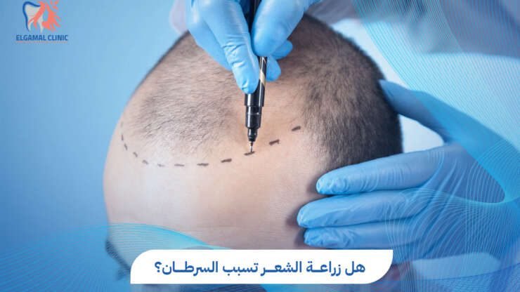 هل زراعة الشعر تسبب السرطان؟ دليل شامل | عيادات الجمل