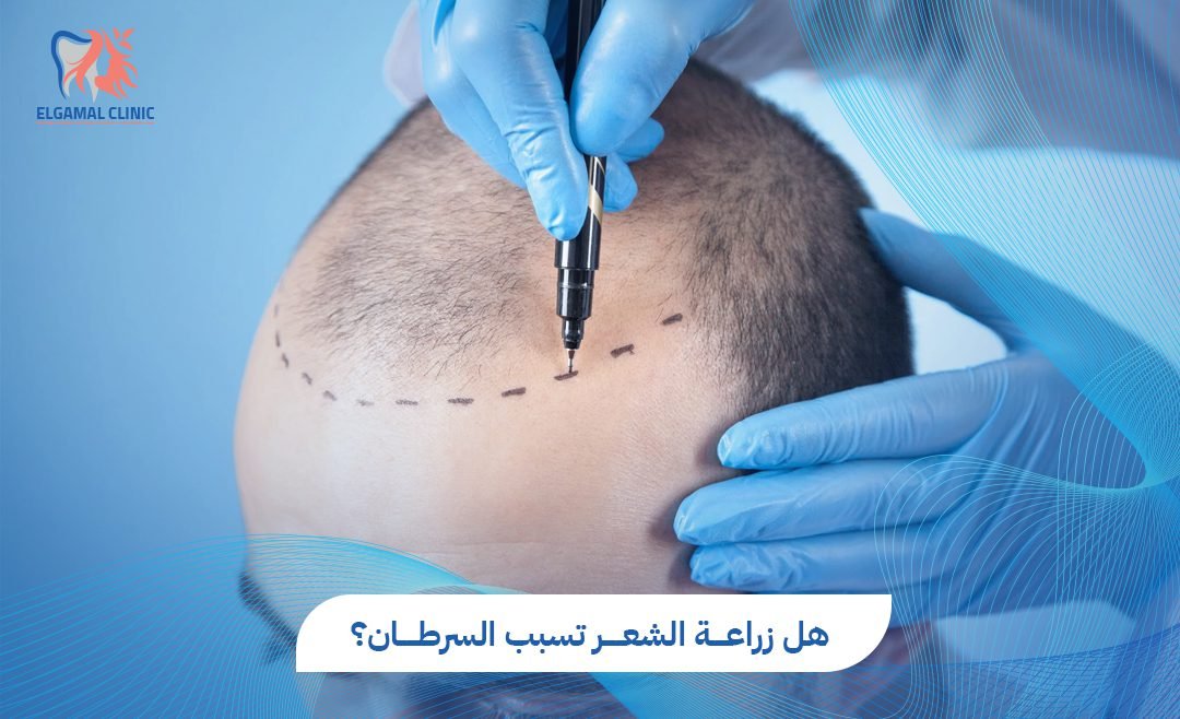 هل زراعة الشعر تسبب السرطان؟ دليل شامل | عيادات الجمل