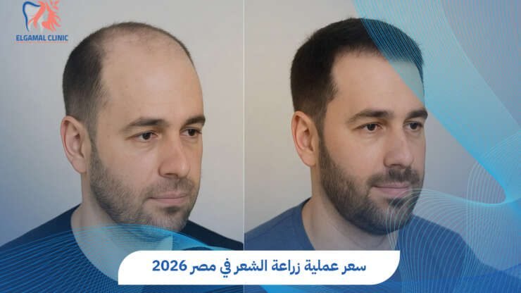 سعر عملية زراعة الشعر في مصر 2026 | عيادات الجمل