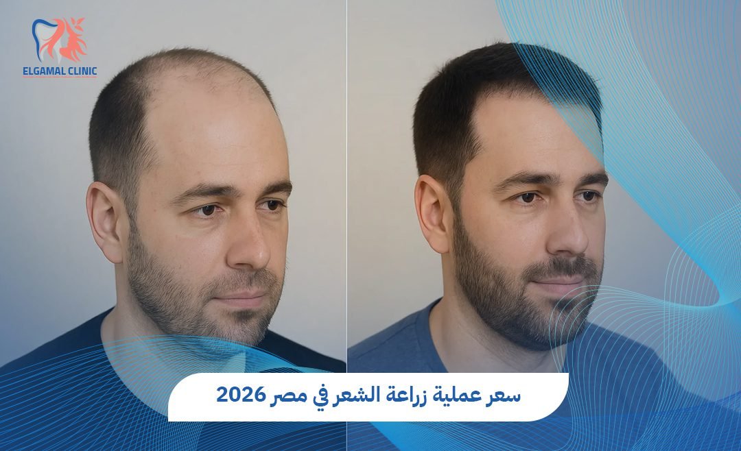 سعر عملية زراعة الشعر في مصر 2026 | عيادات الجمل