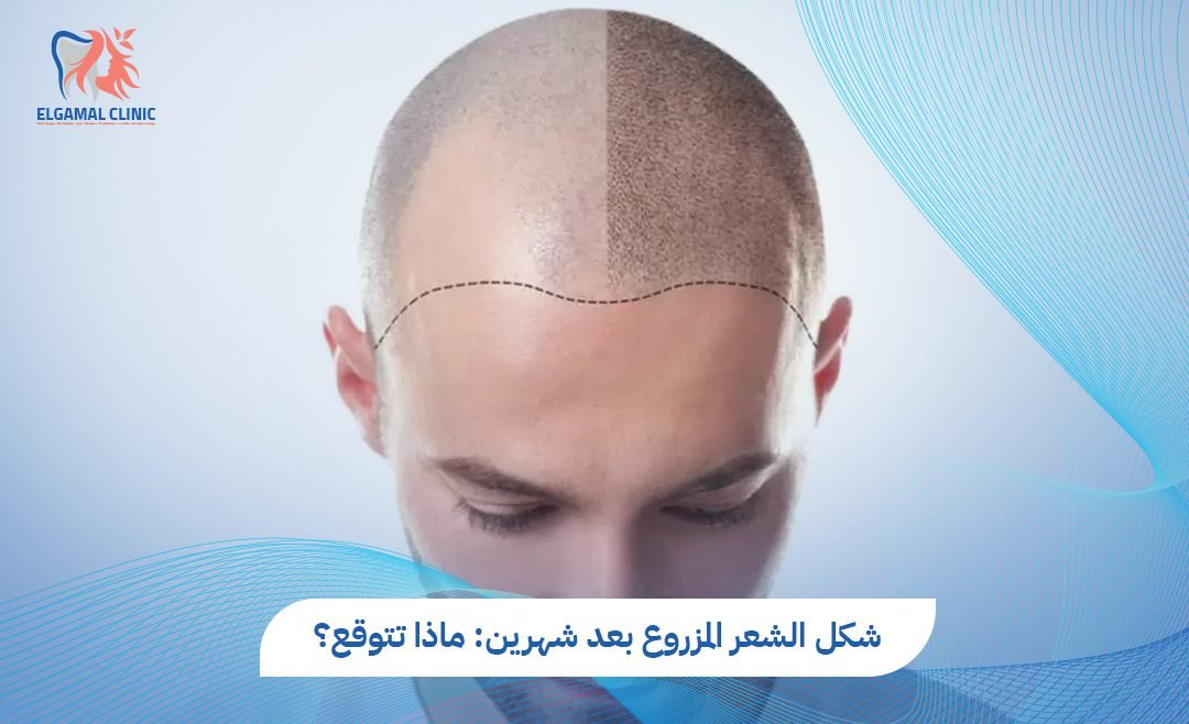 شكل الشعر المزروع بعد شهرين