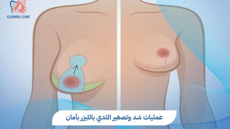 عمليات شد وتصغير الثدي بالليزر مع دكتور احمد لطفي الجمل