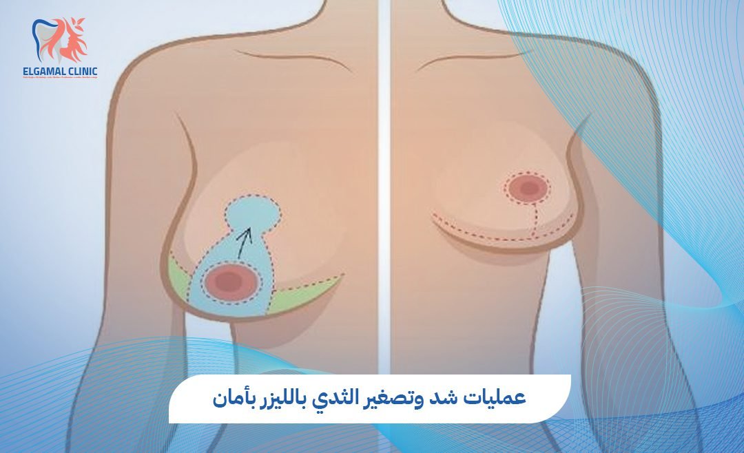 عمليات شد وتصغير الثدي بالليزر مع دكتور احمد لطفي الجمل