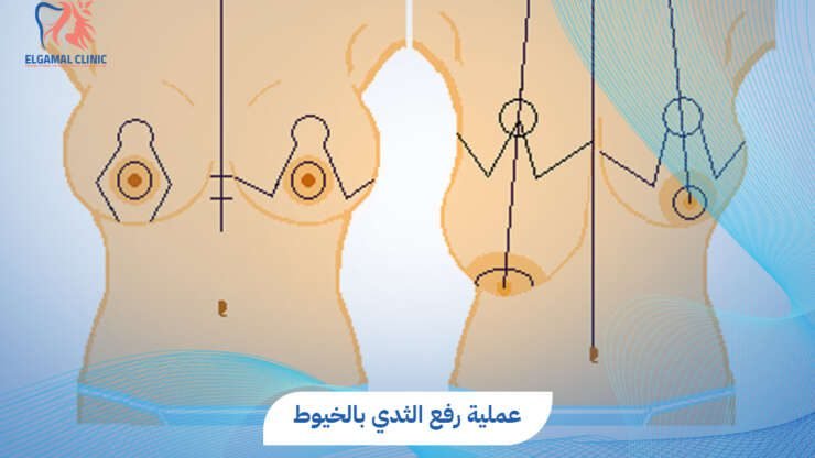 عملية رفع الثدي بالخيوط | عيادات الجمل