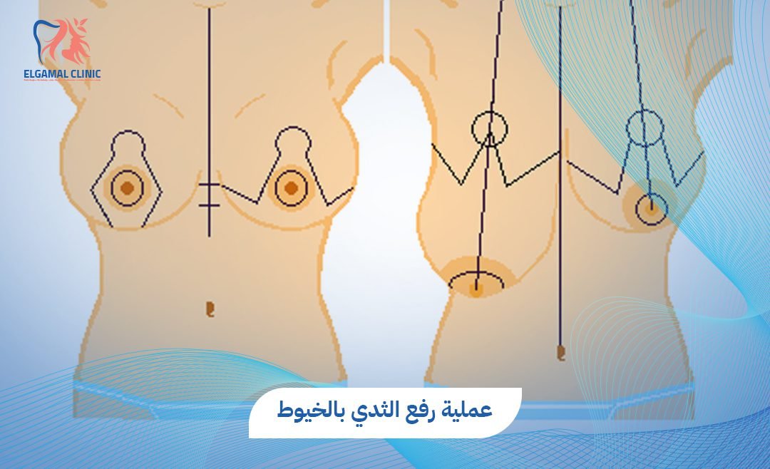 عملية رفع الثدي بالخيوط | عيادات الجمل