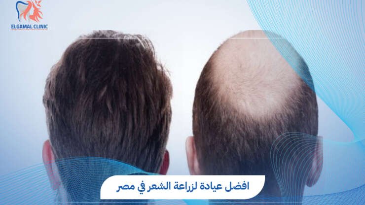 تكلفة زرع الشعر في مصر 2026 | د. أحمد لطفي الجمل
