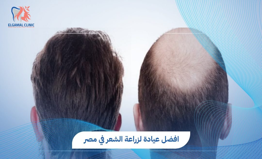 تكلفة زرع الشعر في مصر 2026 | د. أحمد لطفي الجمل