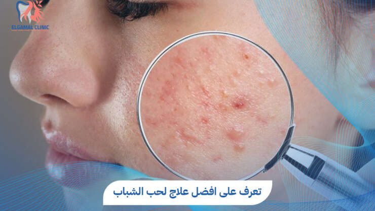 تعرف على افضل علاج لحب الشباب وآثاره | د. قمرية طارق البنا