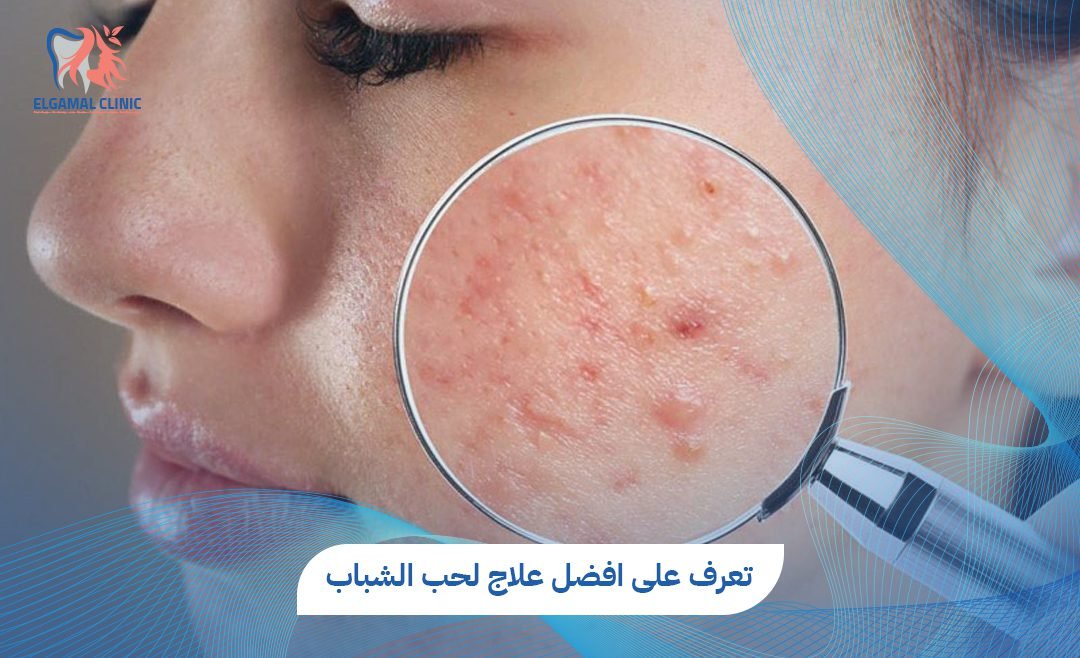 تعرف على افضل علاج لحب الشباب وآثاره | د. قمرية طارق البنا